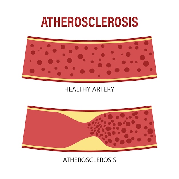 Healthy and atherosclerotic vessels with blood cells Cholesterol in blood vessels Atherosclerotic