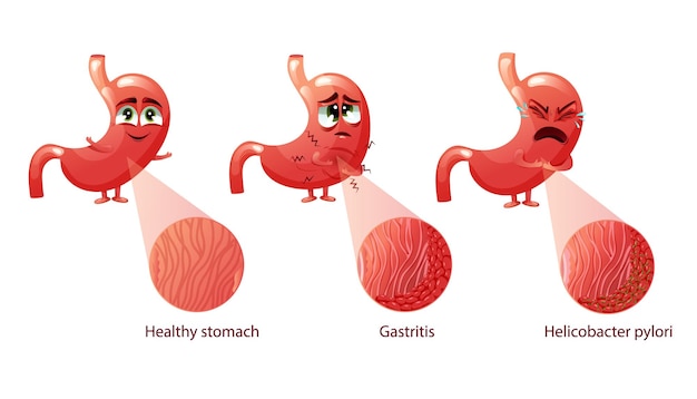 Vector healthy stomach with gastritis and helibacter pylori infection