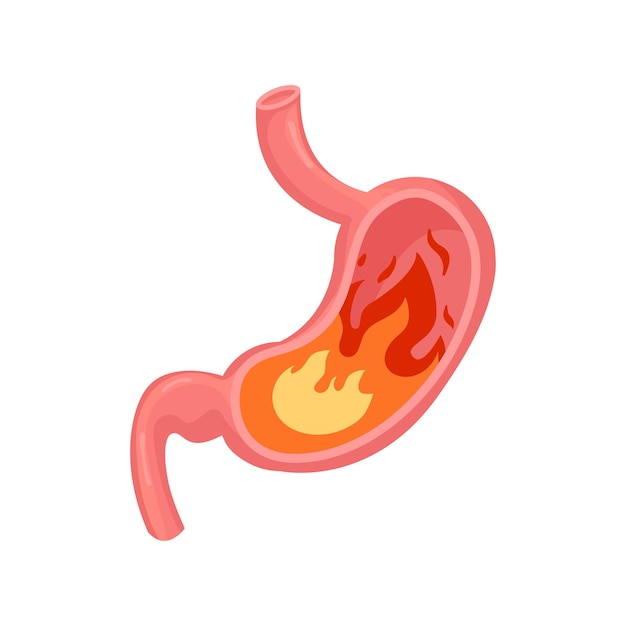 Vector heartburn in the stomach. unhealthy stomach concept. vector illustration in flat style.