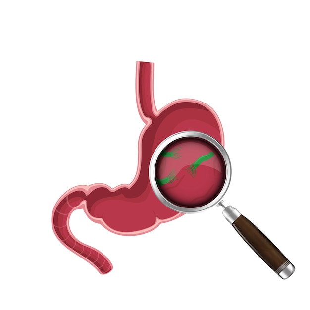 Helicobacter pylori bacteria stomach with Peptic ulcer disease and Magnifying glass Vector illustration