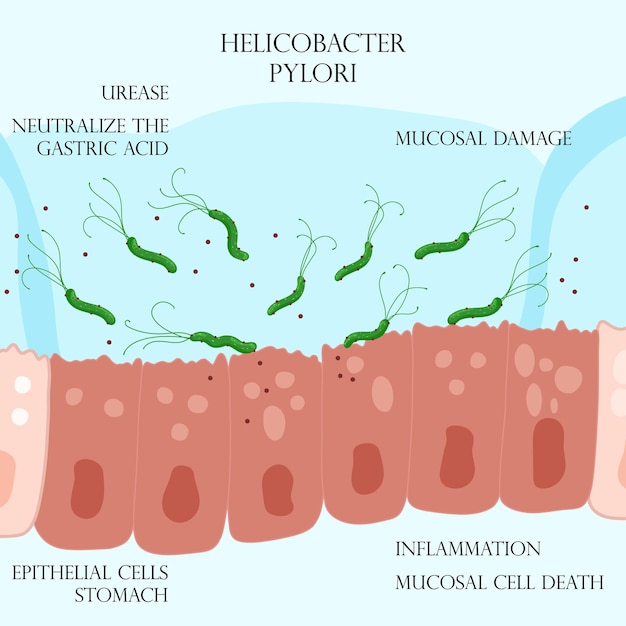 Helicobacter pylori in mucosal layer on inflamed epithelial cells in stomach