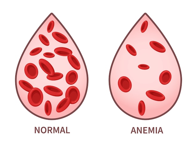 Hemoglobin. Anemia symptoms, blood disease. Health care concept.