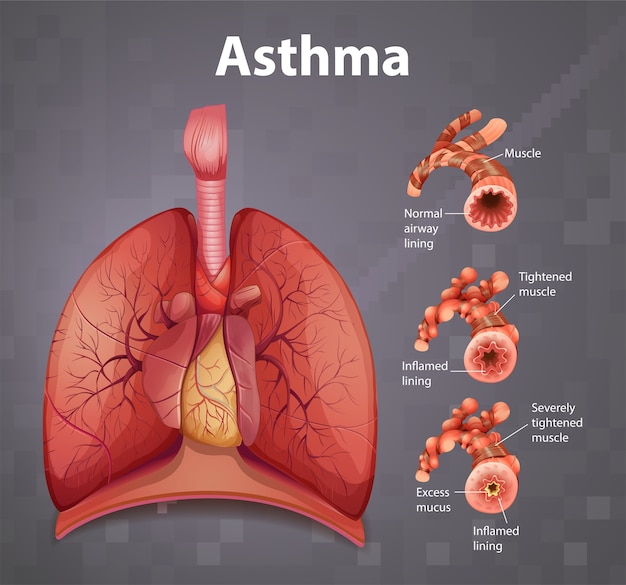 Human anatomy Asthma diagram