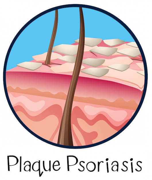 A Human Anatomy Plaque Psoriasis