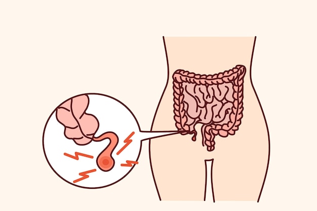 Human body with inflamed appendicitis