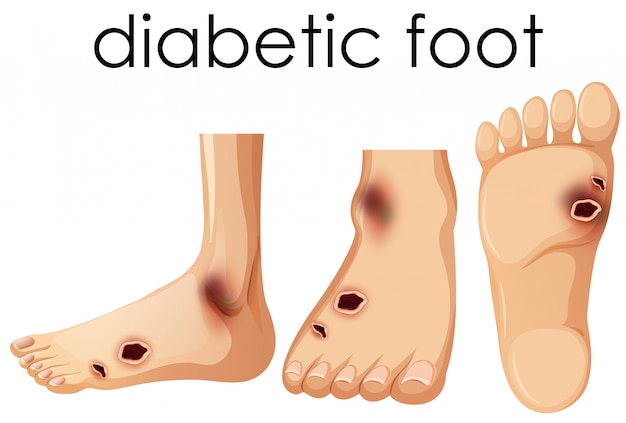 Human Foot with Diabetic 