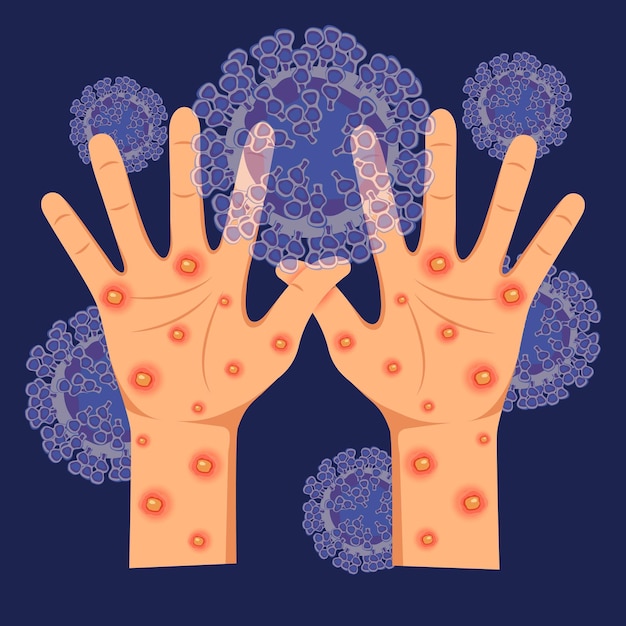 Human hands with monkeypox virus on the microscopic background of the virus Vector illustration