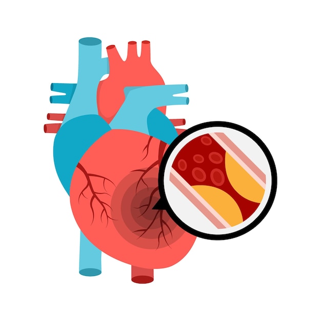 Human heart anatomy with heart attack Atherosclerotic plaque in the blood vessels