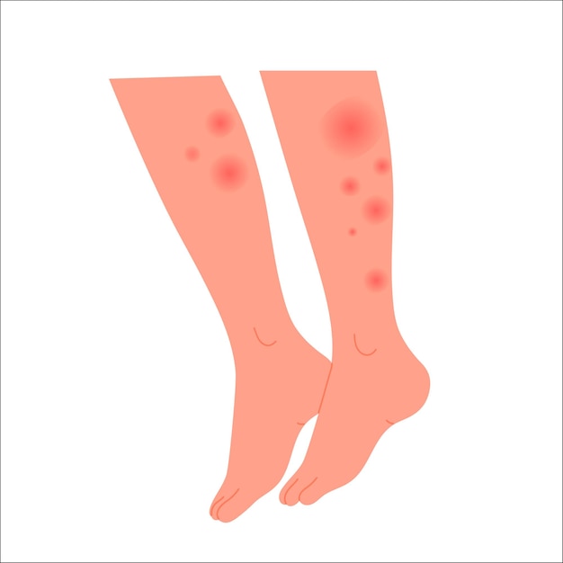 Vector human legs covered with red rash