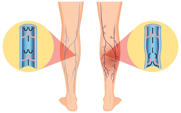 Human legs with varicose vein