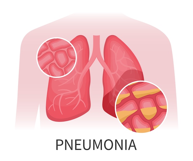 Human lungs that are damaged by pneumonia. Organs damaged by viral disease