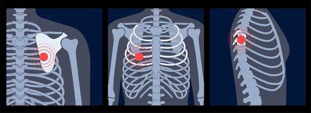 Vector human pain, fracture or inflammation in rib cage. anatomical flat vector illustration