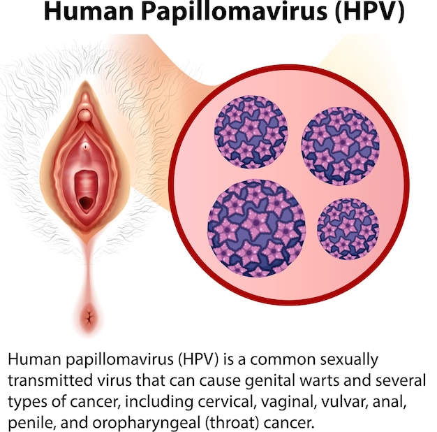 Vector human papillomavirus with explanation