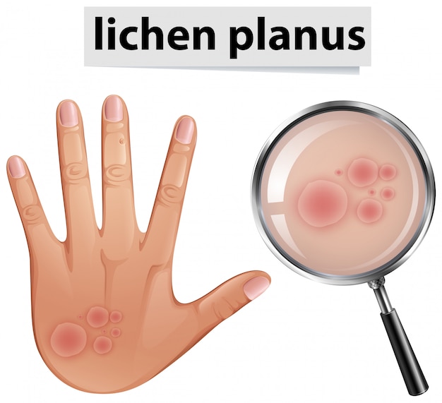 A Human Skin Problem Lichen Planus