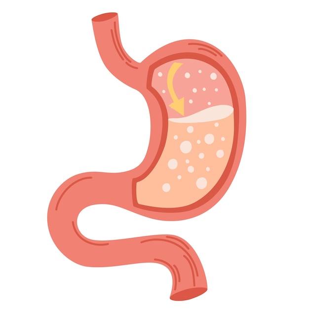 Human stomach Gastroesophageal reflux disease concept Unhealthy stomach concept Heartburn illness discomfort pain Flat vector illustration isolated on white