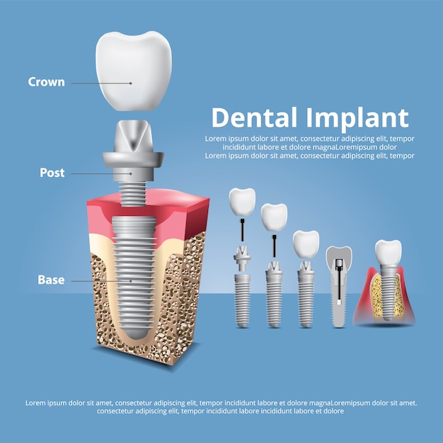 Human teeth and Dental implant Illustration