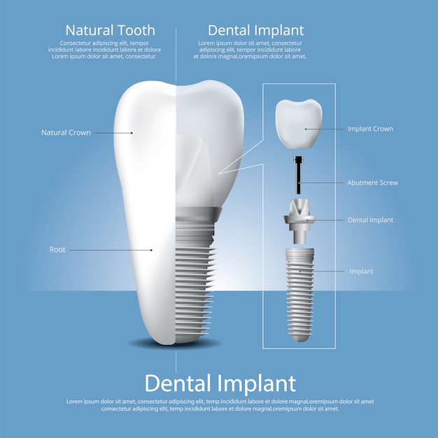 Human teeth and Dental implant