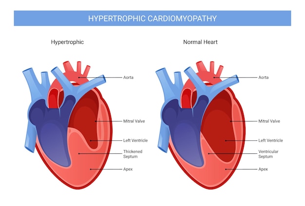 Hypertrophic cardiomyopathy infographic illustration