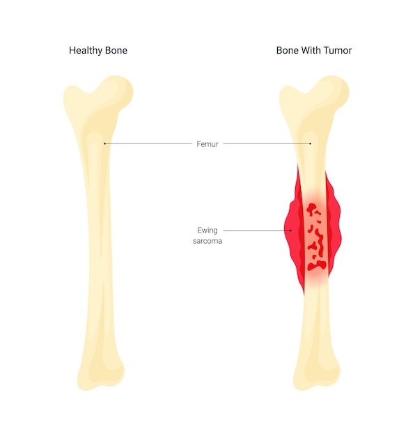 Illustration Diagram of Bone Cancer Disease