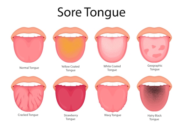 Illustration of tongue symptoms and health medical illustration