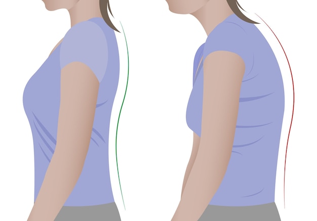 Illustration of a woman's back with a healthy spine and with scoliosis