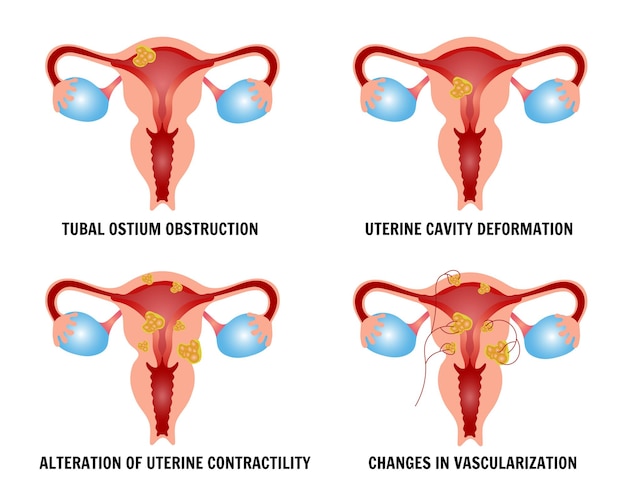 Infographic of fibroids in vector illustration