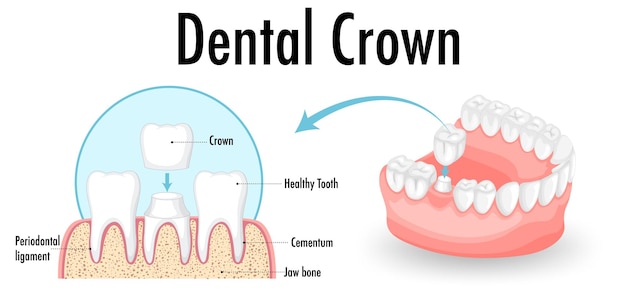 Infographic of human in dental crown