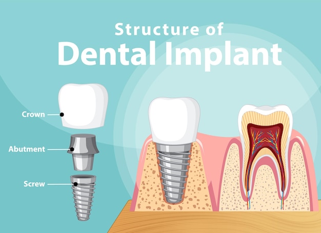 Infographic of human in structure of the dental implant