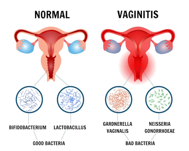 Infographic of normal vaginitis in vector illustration