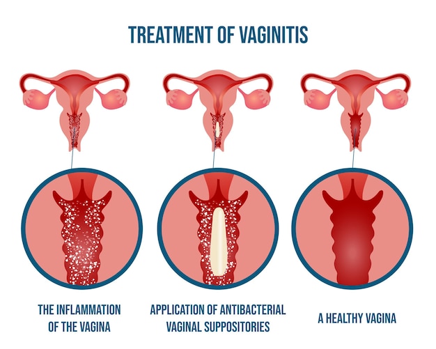 Infographic of treatment of vaginitis in vector illustration