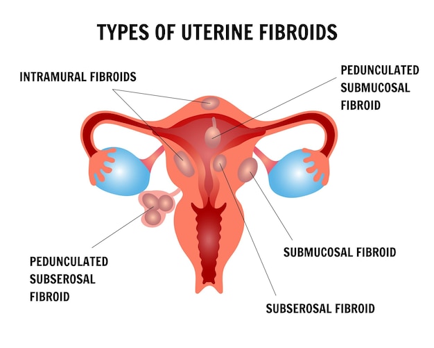 Infographic of types ofuterine fibroids in vector illustration