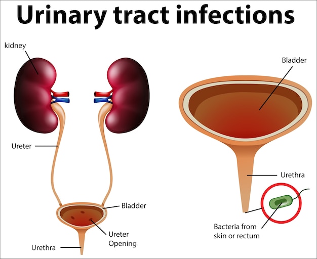 Vector informative illustration of urinary tract infections