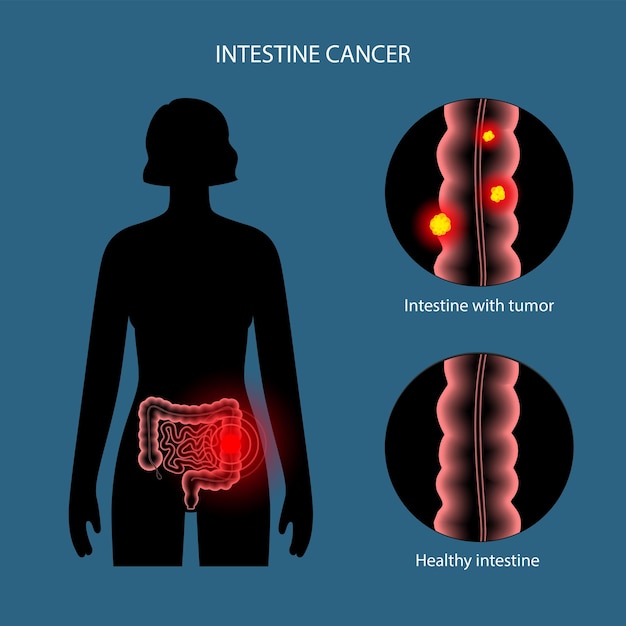 Intestine 3D cancer