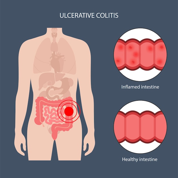 Intestine ulcerative colitis