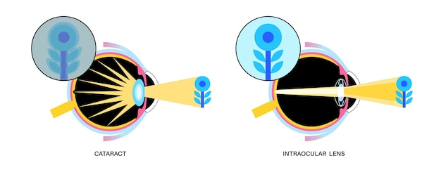 Vector intraocular lenses poster