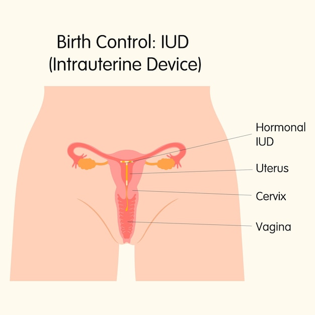 Intrauterine device Contraceptives method IUD Birth control