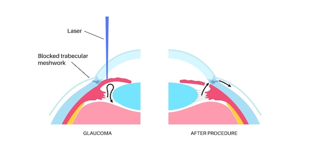 Vector iridectomy medical poster