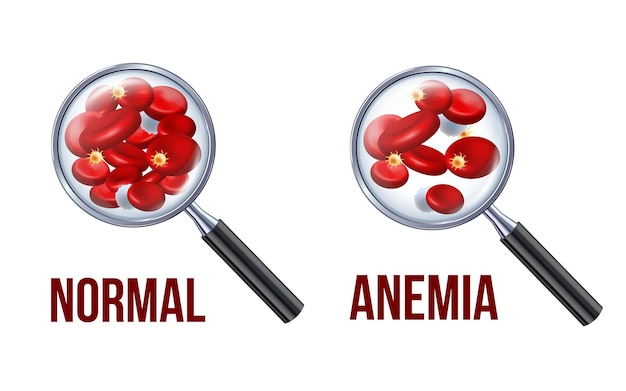 Iron deficiency anemiaThe difference of Anemia amount of red blood cell and normal