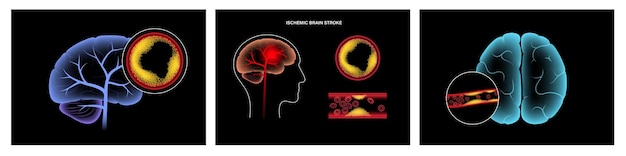 Ischemic brain stroke arteriosclerosis in human head silhouette Cholesterol in blood vessels