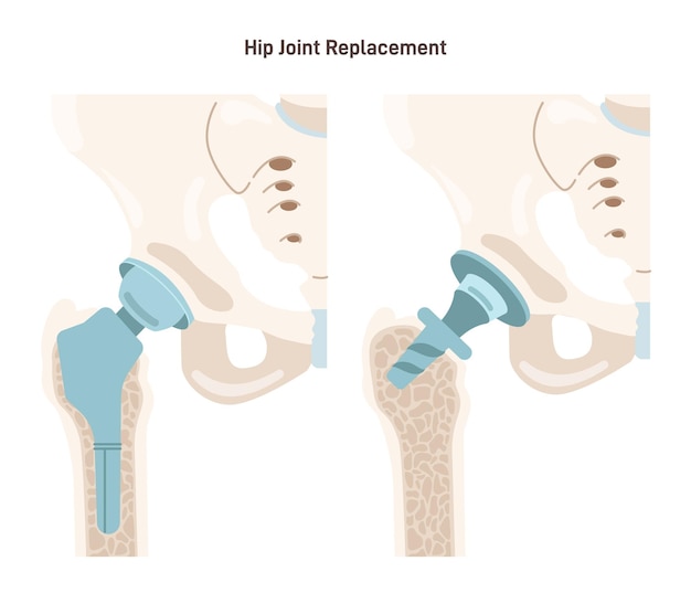 Vector joint implantation injured or distracted human joint replaced with artificial prosthesis made of