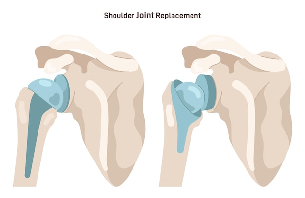 Vector joint implantation injured or distracted human joint replaced with artificial prosthesis made of