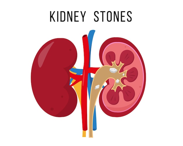 Kidney stone disease. Human kidneys anatomy inside and outside isolated on white