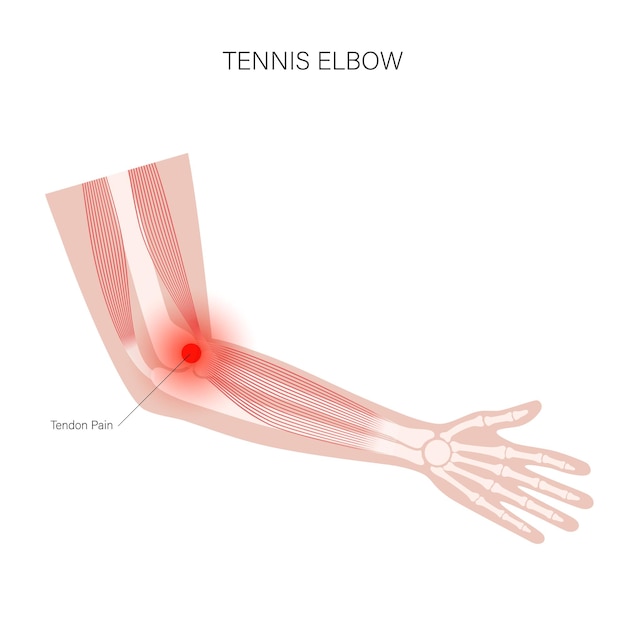 Lateral epicondylitis tennis elbow