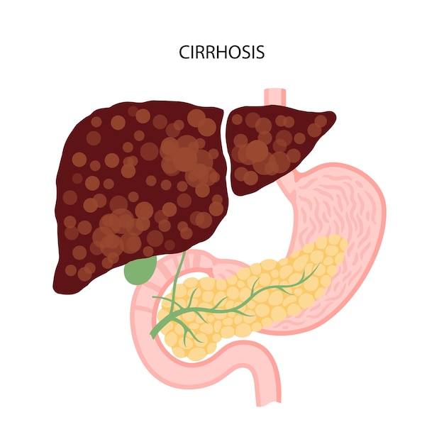 Vector liver disease concept