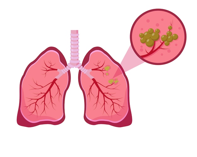 Lung cancer concept. Lung disease illustration on white background.