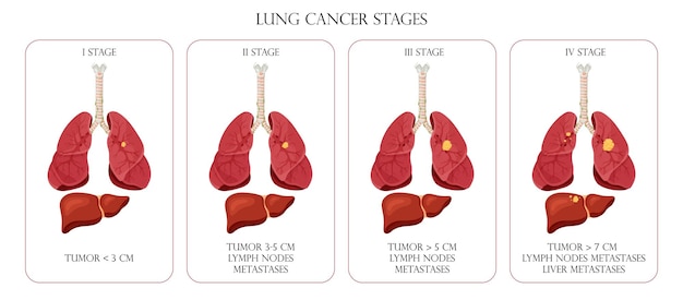 Lung cancer stages Concept diseases human internal organs Cartoon style vector illustration