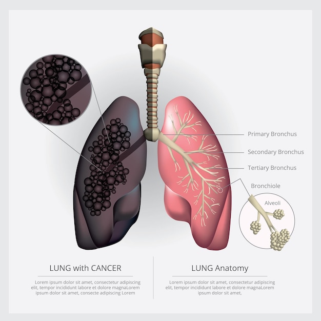 Lung with Detail and Lung Cancer Illustration