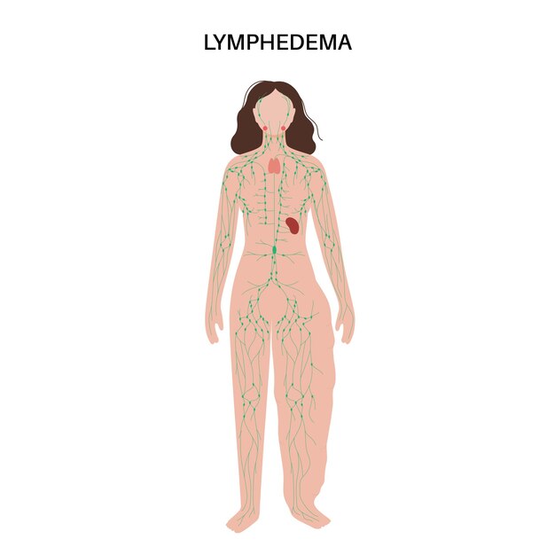 Vector lymphedema leg swelling