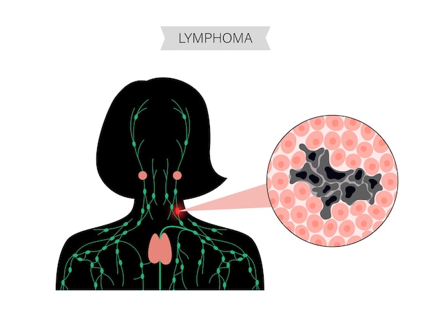 Vector lymphoma cancer concept