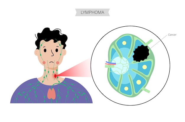 Lymphoma cancer concept